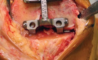 Illustration 22 for Minimize Pain, Maximize Recovery: TKA with Parapatellar