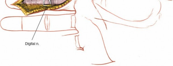 Illustration 152 for Essential Surgical Approaches: Uncover Every Aspect of the Wrist