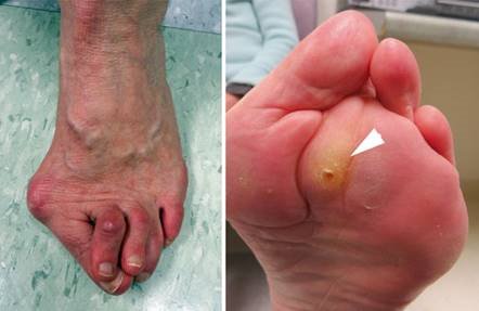 Illustration 71 for First Metatarsal Surgery: Expert Solutions for Foot & Ankle Pain