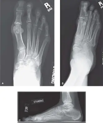 صورة توضيحية لـ الدليل الشامل لعدم استقرار مفصل المشط السلامي الثاني: الأسباب، التشخيص، والعلاج المتطور