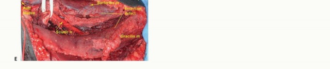 صورة طبية: استئصال أورام العضلات المقربة في الفخذ: الحفاظ على الطرف بتقنيات متقدمة مع الأستاذ الدكتور محمد هطيف في صنعاء