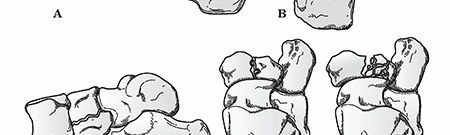 Illustration 11 for Mastering First MTP Joint & Forefoot Fractures: A Comprehensive Guide