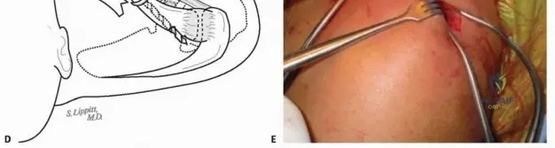 Illustration of displaced midshaft clavicle - Dr. Mohammed Hutaif