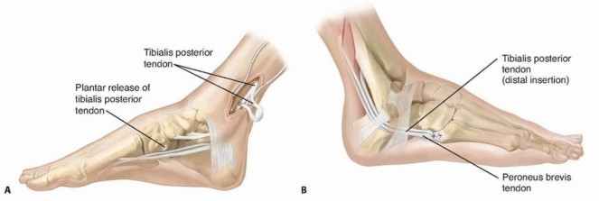Preventing Overcorrection: Split Tibialis Posterior Tendon Transfer