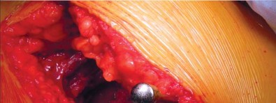 صورة طبية: تقنية الجذع القصير لاستبدال مفصل الورك الكلي: نهج الأستاذ الدكتور محمد هطيف لتدخل جراحي أقل ونتائج أفضل