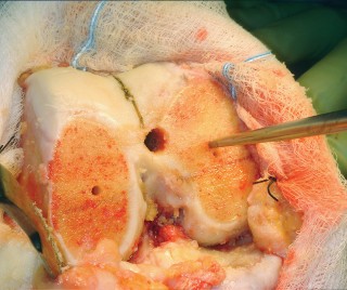 Illustration 43 for Mastering TKA: Essential Methods of Rotational Alignment