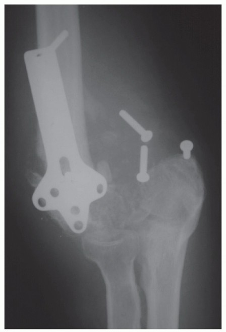 Arthroplasty for Posttraumatic Elbow Conditions: Find Your Solution