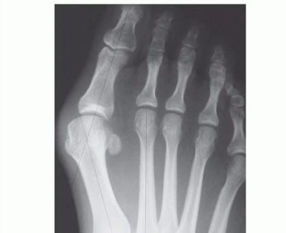Mau Osteotomy: Precision Bunion Fix to Achieve Less Than Degrees