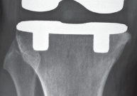 Illustration 20 for Monoblock Total Knee: When to Use & What to Avoid