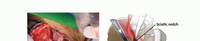 Illustration 19 for Restore Hip Health: Pelvic Osteotomy for Acetabular Dysplasia & CEA of Less