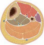 Pediatric Tibial Fractures: Avoid Mistakes, Ensure Optimal Healing