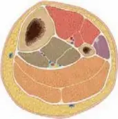 صورة توضيحية لـ كسور قصبة الساق لدى الأطفال: دليل شامل للآباء نحو التعافي الآمن
