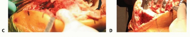 Illustration 5 for Removal of Well-fixed Components: Safe Techniques for Revision TKA