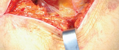 Illustration 15 for Unlock the Figure Posterior Approach to the Hip