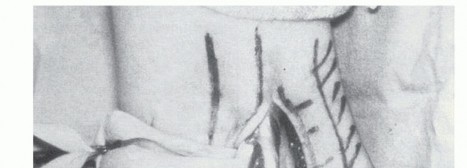 Illustration of peroneal tendon subluxation - Dr. Mohammed Hutaif