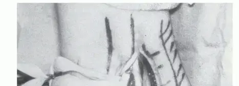 صورة توضيحية لـ خلع الأوتار الشظوية: دليلك الشامل للتعافي وتجنب الألم المزمن مع الدكتور محمد هطيف