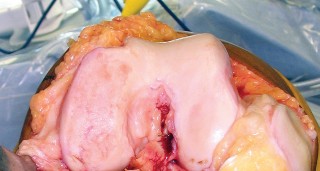 Illustration 4 for Monoblock Total Knee: When to Use & What to Avoid