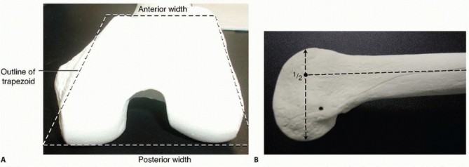 Mastering Fixation of the Distal Femur: Avoiding Complex Outcomes