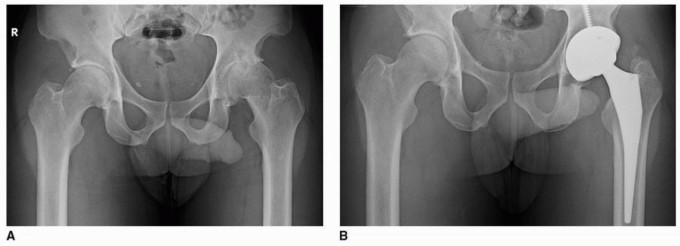 صورة طبية: تثبيت مفصل الورك بدون أسمنت: دليل شامل لمرضى استبدال الورك مع الأستاذ الدكتور محمد هطيف