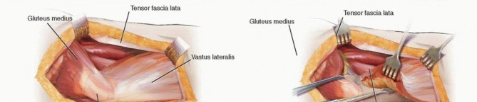 Illustration 8 for Proximal Femoral Osteotomy: When This Hip-Saving Surgery Is Performed