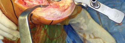 Illustration 32 for Minimize Pain, Maximize Recovery: TKA with Parapatellar