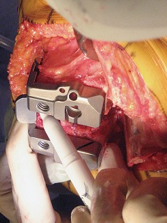 Illustration 35 for Posterior Stabilized Technique: Essential Insights for TKA Success