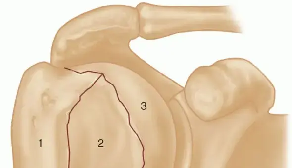 صورة توضيحية لـ كسر الجزء العلوي من عظم العضد: دليل شامل للمرضى لاستعادة صحة الكتف في اليمن والخليج