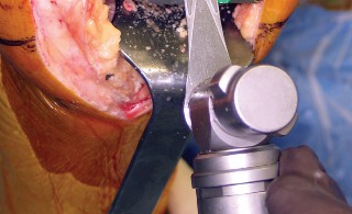 Illustration 30 for Minimize Pain, Maximize Recovery: TKA with Parapatellar