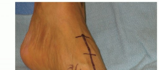 Lapidus Procedure: Effective Solutions for First TMT Joint Instability