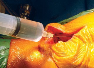 Illustration 25 for Cemented TKA Figure: Your Visual Guide to Surgical Success