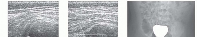 The Medial Open Reduction Approach: Keys to Success