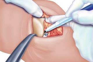 Illustration 30 for Unicompartmental Knee Arthroplasty: Master decisions with this b c figure guide.