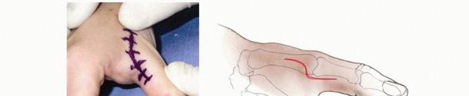 Reconstruction of Chronic Radial and Ulnar Instability of the Thumb Metacarpophalangeal Joint