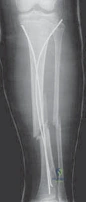 Proximal Humeral fractures Clinical And Radiographic Assessment Of Patients With Suspected Proximal Humeral Fractures