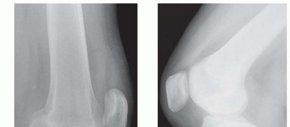 Posterior Cruciate Ligament Surgery: Regain Knee Strength & Stability
