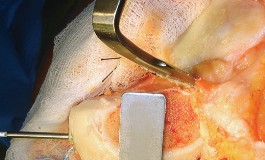 Illustration 28 for Mastering TKA: Essential Methods of Rotational Alignment