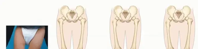 نقص عظم الشظية عند الأطفال: دليل شامل لخيارات العلاج مع الأستاذ الدكتور محمد هطيف