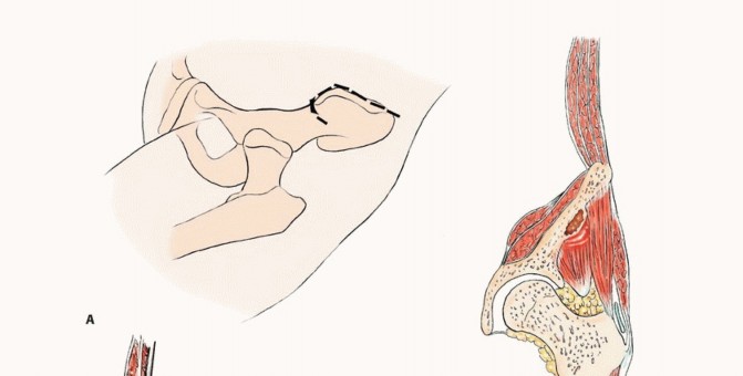 توضيح طبي: جراحة نقائل الحوض: حل شامل لآلام العظام واستعادة الحركة مع الأستاذ الدكتور محمد هطيف