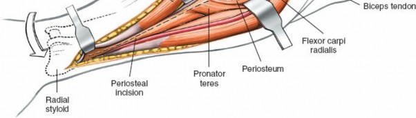Illustration 16 for Mastering Approaches to the Upper Third of the Radius