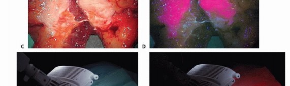 صورة طبية: الاستئصال الموجه لأورام الجهاز العضلي الهيكلي: نهج أكثر أمانًا وفعالية مع الأستاذ الدكتور محمد هطيف
