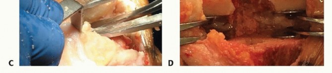 Illustration 30 for Achieve Lasting Pain Relief with Cemented Total Knee Arthroplasty