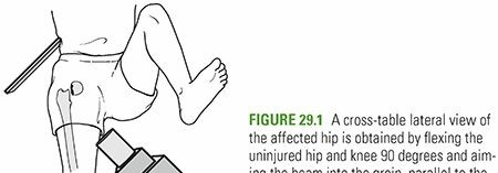 Illustration of neck fractures femoral - Dr. Mohammed Hutaif