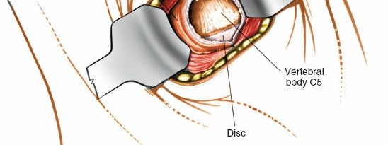 Illustration 23 for Mastering the Anterior Cervical Approach: Longus Colli Muscle Insights