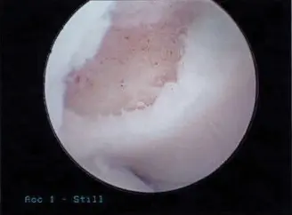 صورة توضيحية لـ التهاب العظم والغضروف السالخ بالمرفق: دليلك الشامل للتشخيص والعلاج مع الأستاذ الدكتور محمد هطيف