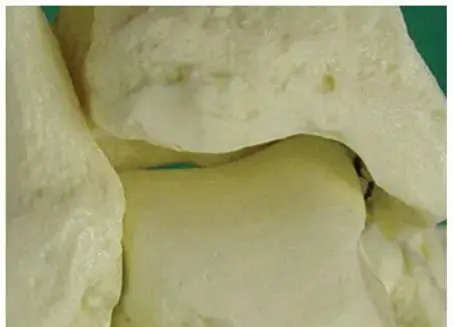 وداعاً لآلام الكاحل الخلفية: دليلك الشامل لمتلازمة الانحشار وعلاجها بالمنظار مع الأستاذ الدكتور محمد هطيف