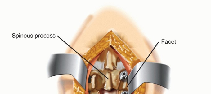Illustration 5 for Revision Lumbar Surgery: When Failed Back Syndrome Requires Reoperation