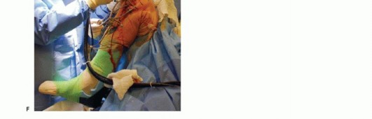 Illustration 24 for Unicondylar Knee Arthroplasty: Is This Your Solution to Knee Pain?