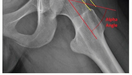 Illustration 8 for Restore Hip Health: Pelvic Osteotomy for Acetabular Dysplasia & CEA of Less