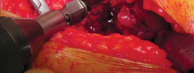 صورة طبية: تقنية الجذع القصير لاستبدال مفصل الورك الكلي: نهج الأستاذ الدكتور محمد هطيف لتدخل جراحي أقل ونتائج أفضل