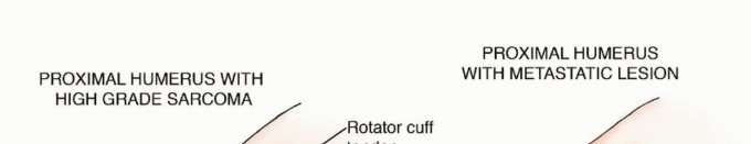 Restore Vital Function: Surgery for Type II Humeral Metastasis